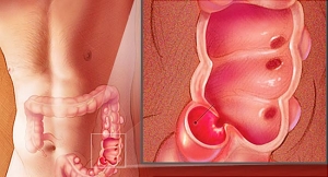 Doença diverticular do cólon e diverticulite aguda