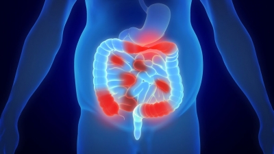 Doenças Inflamatórias Intestinais