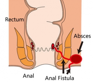 Fístula anal