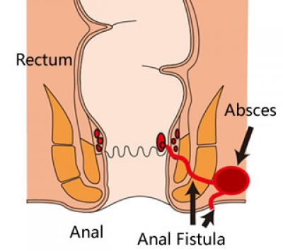 Fístula anal