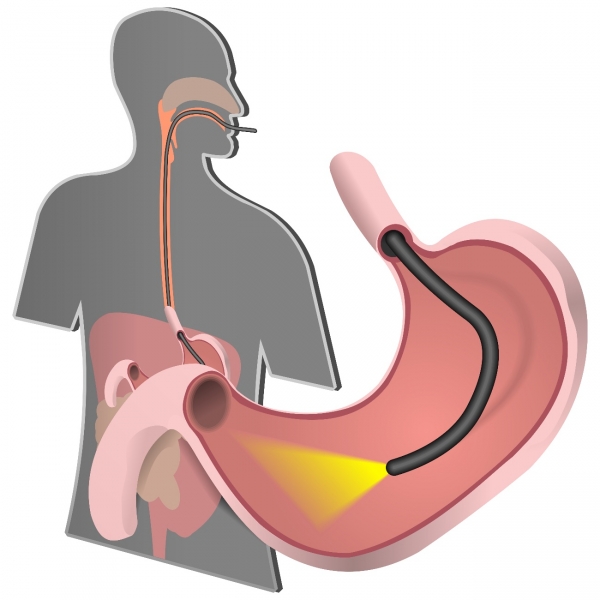 Endoscopia Digestiva Alta