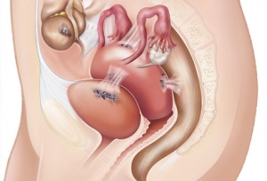 Endometriose