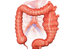 Diverticulite ou Diverticulose?